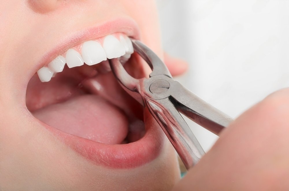 Tooth Extractions and Impactions in Kochi, Kerala