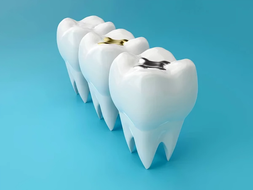 Best Teeth Filling Treatment in Kerala