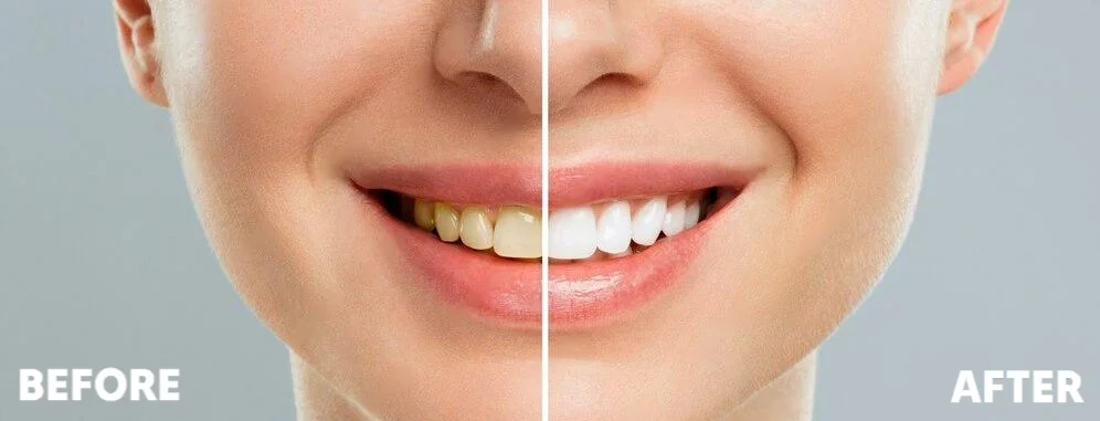 best dental clinic for teeth whitening