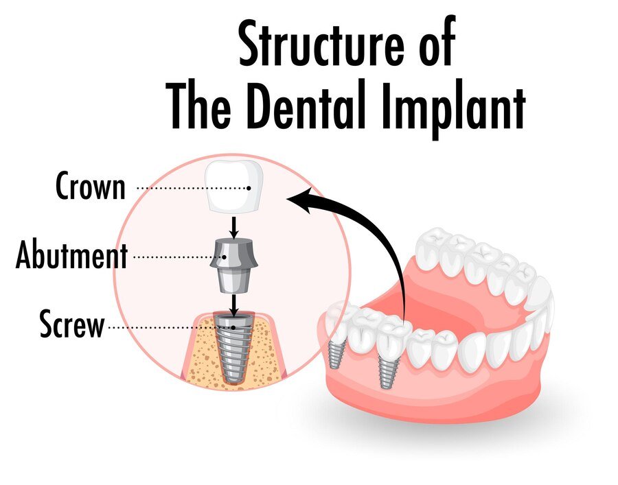 teeth implant cost in kerala